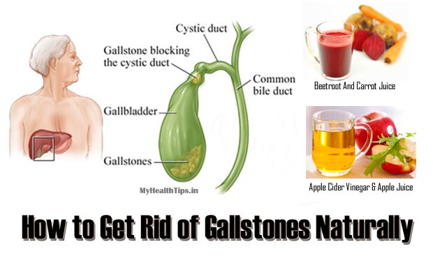 9 Best Natural Home Remedies for Gallstones