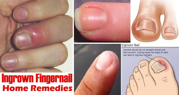 How To Get Rid Of Ingrown Fingernails